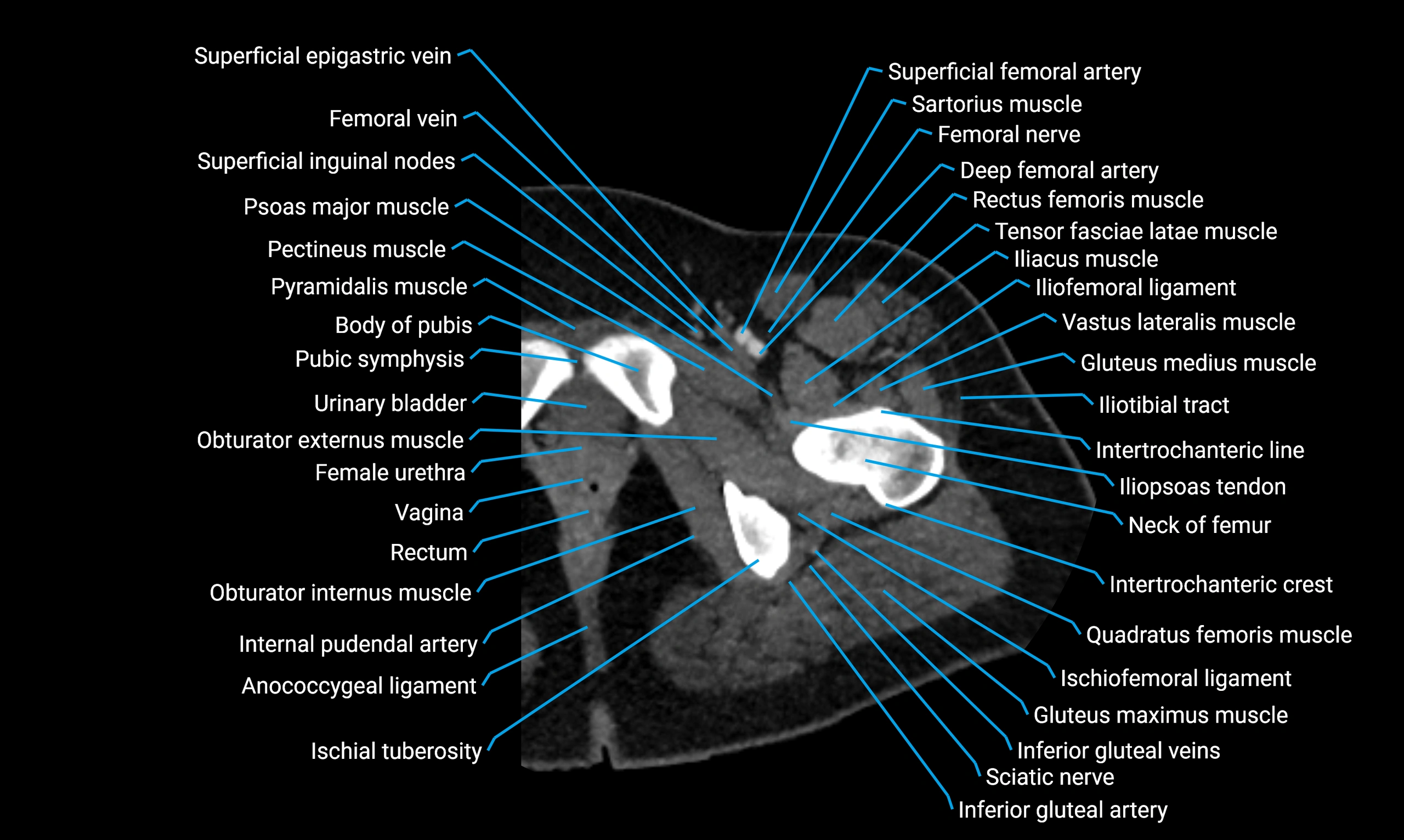 CT thigh axial cross sectional anatomy labelled image_12 (1).webp